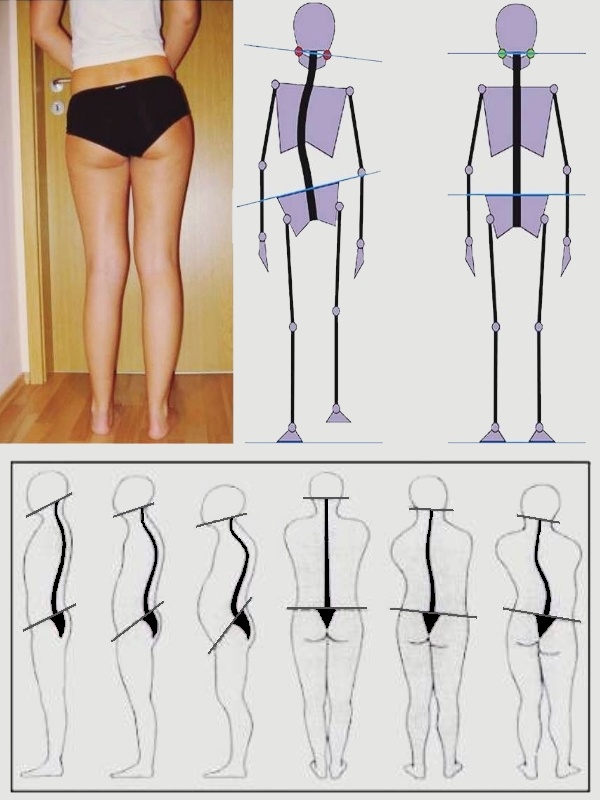 Beckenschiefstand durch Beinlängendifferenz, ab einer Differenz von 0,5cm sollte eine Therapie erwogen werden. Beinlängendifferenz, Skelett Fehlstellung, Seitenabweichung der Wirbelsäule